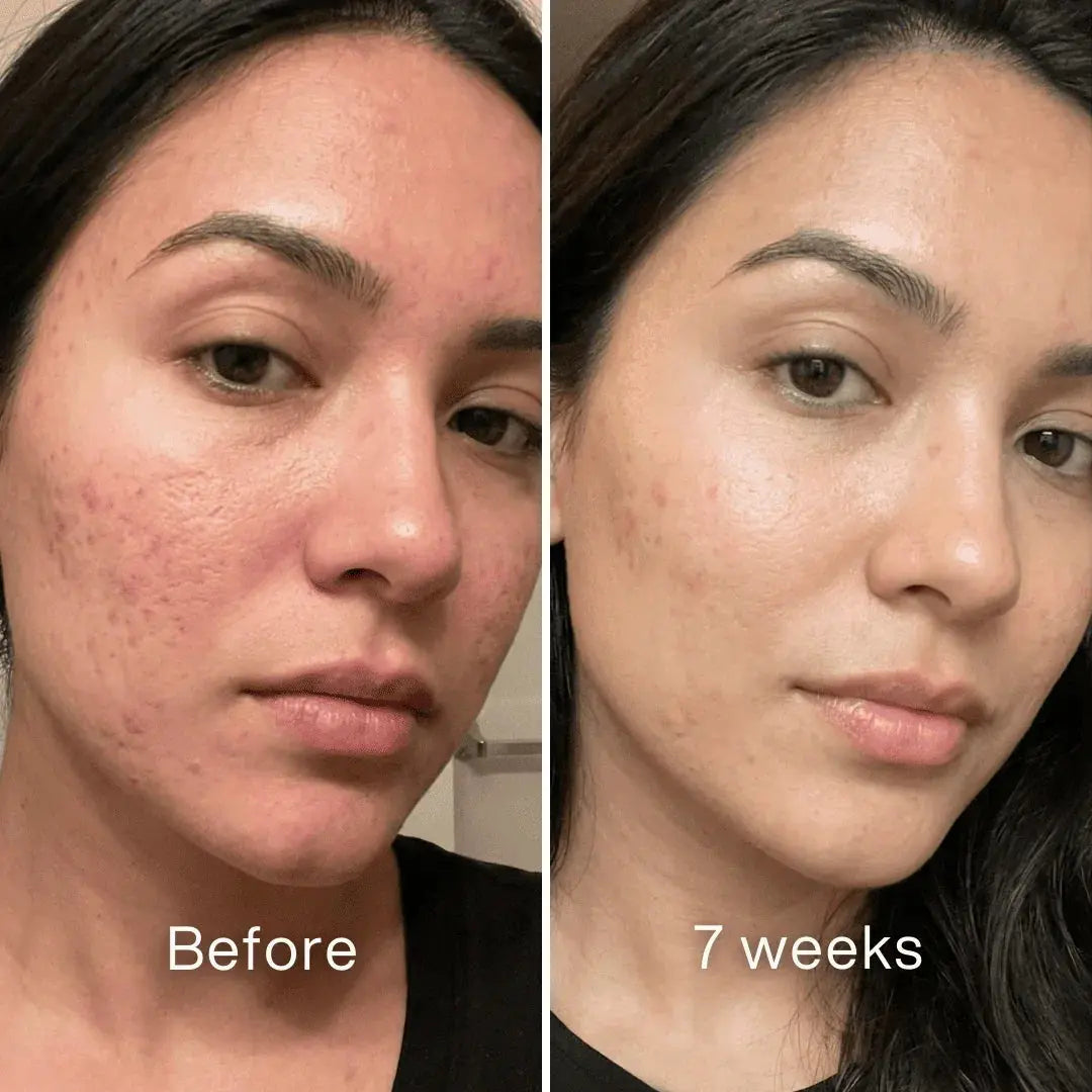 Acne Scar Repair Stick™