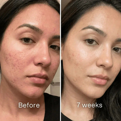 Acne Scar Repair Stick™