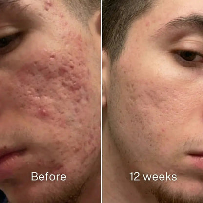 Acne Scar Repair Stick™